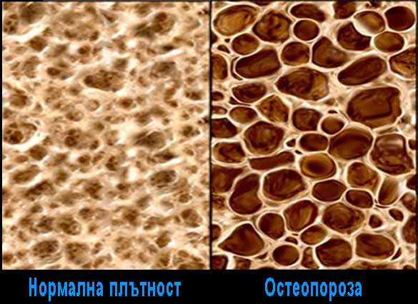 ОСТЕОПОРОЗА ЛЕЧЕНИЕ